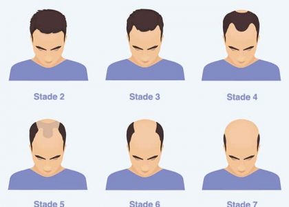 Hair transplant in Turkey