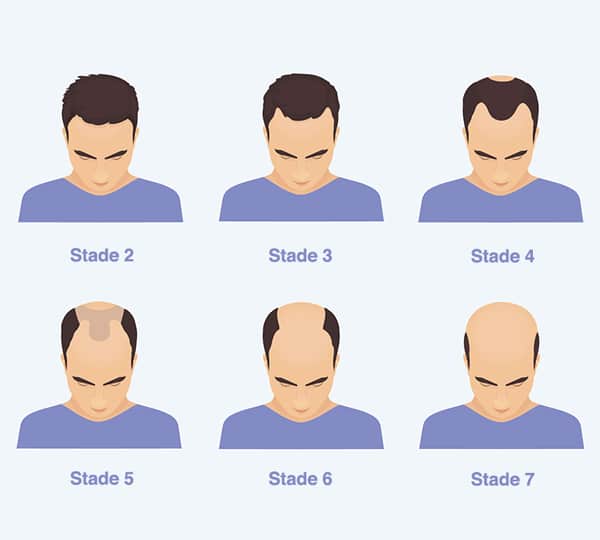 Hair transplant in Turkey